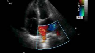 Transthoracic ECHO Pulmonary Veins [upl. by Myrah225]