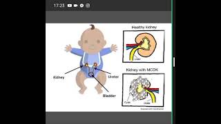 MCDK Multicystic Dysplastic Kidney in hindi Multicystickidney [upl. by Leopold]