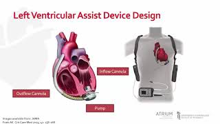 Left Ventricular Assist Device Management [upl. by Garlaand]