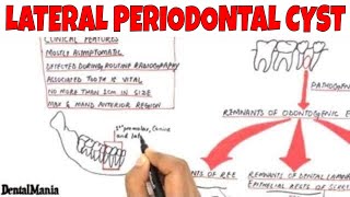 Lateral periodontal cyst  Pathogenesis Clinical Radiographic and Histopathologic features [upl. by Adelle]