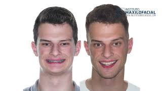 Jaw surgery Case  105 Gustavo  Short face overbite maxilomandibular retrusion [upl. by Muir]