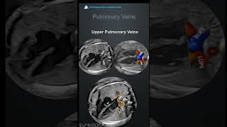 All pulmonary veins on fetal echocardiography echosingh fetalechocardiography [upl. by Shaya225]