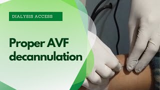 AVF Decannulation procedure  avf cannulation techniques [upl. by Euqirat]