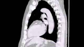 Lytic lesions in multiple myeloma lower res [upl. by Illah370]