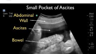 Ultrasound video showing Ascites ascites medicalmasti  ultrasoundvideoascites medicalmasti [upl. by Kirimia243]