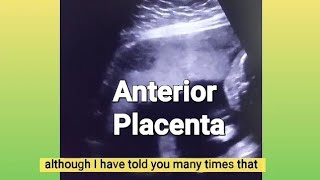 Anterior placenta baby gender  12 weeks Twin pregnancy  3 vessel cord or turtle sign  ultrasound [upl. by Nahtanhoj462]