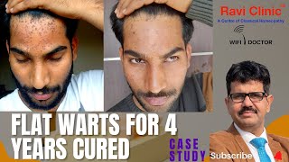 Flat Warts for 4 years from Gwalior Treated online [upl. by Novehc462]