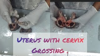 uterus with cervix spceimen grossing video😨 uterusproblem cervix ovariancyst cyst fibroadenoma [upl. by Tiny]