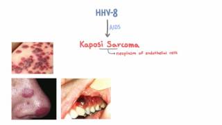 HHV8 and Kaposi Sarcoma [upl. by Letha]