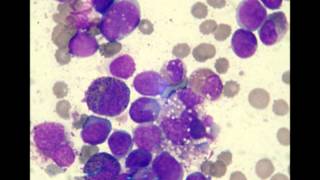 Acute Myelomonocytic Leukemia M4 EO 2 patients [upl. by Derfnam238]