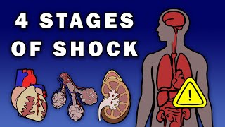 THE 4 STAGES OF SHOCK [upl. by Imnubulo]