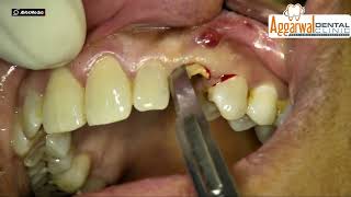 Immediate implant placement with TSIII CA implant and GBR using A Oss Collagen [upl. by Ahsekahs]