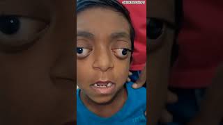 Crouzon Syndrome Key Facts in 24 Seconds eyes mbbs neetpg neet ophthalmology aiims medical [upl. by Moyra]