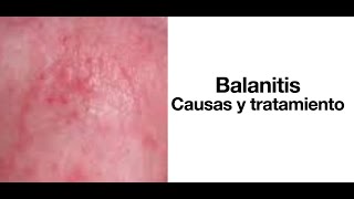 Balanitis Causas y tratamiento  Cura de la balanitis [upl. by Nycila]