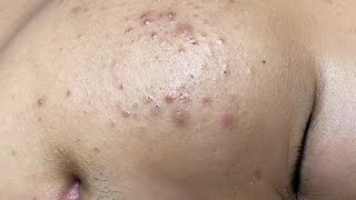 ACNE TREATMENT VU QUYNH MI Blackheads On Boy Face 2024 [upl. by Erroll]