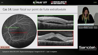 Cas cliniques au laser rétinien Navilas 577s  Dr Francesca AMOROSO et Dr Alexandre PEDINIELLI [upl. by Longwood590]