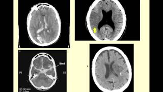 Stroke Syndromes  CRASH Medical Review Series [upl. by Sirkin]