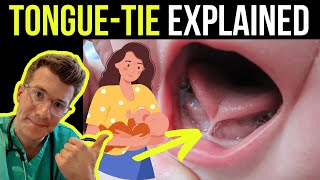 Doctor explains tongue tie in babies ankyloglossia  including treatment options [upl. by Esta]