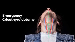 Performing an Emergent Cricothyroidotomy  MEDZCOOL [upl. by Nate]