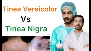 Tinea Versicolor Vs Tinea Nigra [upl. by Nuahsyt287]