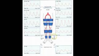 Amputee donning the Transtibial Below Knee NPS Elevated Vacuum Socket System [upl. by Nahum]