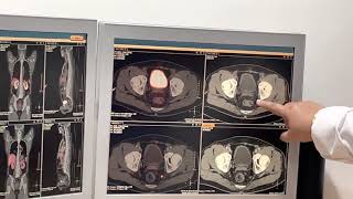 Video 1 PSMAPET Scan results after my Lutetium177 LU177 prostate cancer treatment [upl. by Nnail]