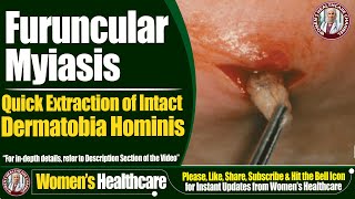 Furuncular Myiasis  Quick Extraction of Intact Dermatobia Hominis  Womens Healthcare [upl. by Yatnuahs]