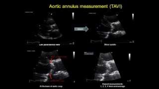 AORTIC ANNULUS MEASUREMENT  TAVI  transcatheter aortic valve implantation [upl. by Noret723]