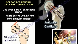 Hip Fractures  Everything You Need To Know  Dr Nabil Ebraheim [upl. by Drhacir]