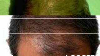 PRP Hair Loss Treatment Bangladesh [upl. by Garratt]