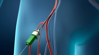 Coronary Angioplasty Femoral Access [upl. by Maffa]