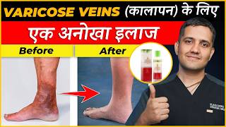 Varicose Veins  Side Effect of Long Standing and Seating Job  Best Treatment  Dr Gaurav Gangwani [upl. by Ecirtaemed]