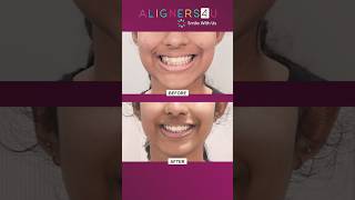 Your Aligners Journey From Start to Stunning Smile  Clear Aligners Braces  Hyderabad  India [upl. by Mccormac]