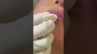 Lip Filler Treatment ✨ [upl. by Jaquenette396]