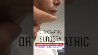 Who Needs Orthognathic  Corrective Jaw Surgery [upl. by Nasya]