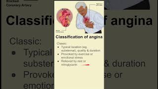 Classification of angina [upl. by Cari]