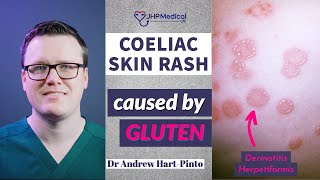 Dermatitis Herpetiformis Skin Rash Linked To Coeliac Disease Celiac And Gluten Intolerance [upl. by Balsam]