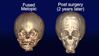 Metopic Synostosis [upl. by Aiht]