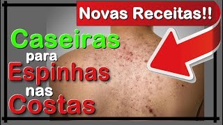 🔴 ESPINHAS NAS COSTAS  COMO ACABAR COM ESPINHAS NAS COSTAS EM 24 HORAS OU MENOS RECEITA CASEIRA [upl. by Yeoz230]