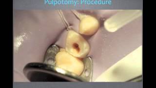 Pulp Therapy and Primary Tooth Pulpotomy  Video Review [upl. by Steinway879]