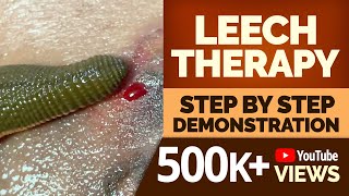 LEECH THERAPY Step by Step Demonstration [upl. by Ardyce571]