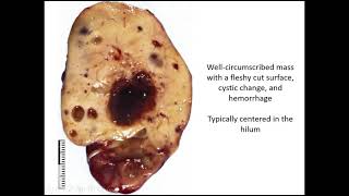 Renal Tumors Case 7 [upl. by Dustan]