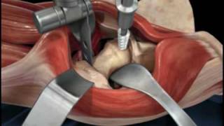 Direct Anterior Approach Hip Replacement [upl. by Ziom214]