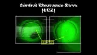 The ICD 165 and 145 Mini Scleral Lenses [upl. by Phelips300]