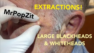 Awesome acne extractions Some solar comedones Favre some regular blackheads and whiteheads [upl. by Lindsy]