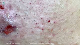 Big Cystic Acne Blackheads Extraction Blackheads amp Milia Whiteheads Removal Pimple Popping [upl. by Melisa]