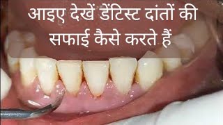 Teeth cleaning  scaling  tartar removal दांत साफ कैसे होते है teethcleaning dentist [upl. by Anav828]