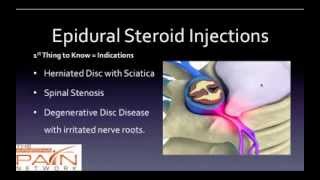 5 Things to Know About Epidural Steroid Injections 602 5076550 [upl. by Adamik]