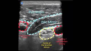 Infraclavicular block with Houdini manoeuvre ultrasound guided [upl. by Clint]