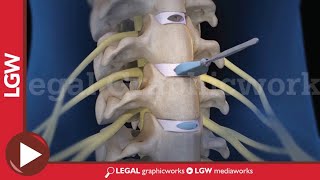 Cervical Discectomy amp Fusion Surgery 3D animation C3 C4 C5 C6 [upl. by Shig]